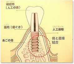 インプラントの模式図